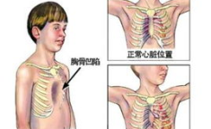 漏斗胸的图片,从成因到治疗，全面解析这一儿童常见胸廓畸形